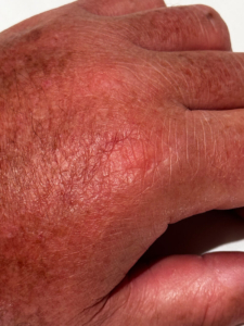Roger Muller's swollen hand from lionfish sting.